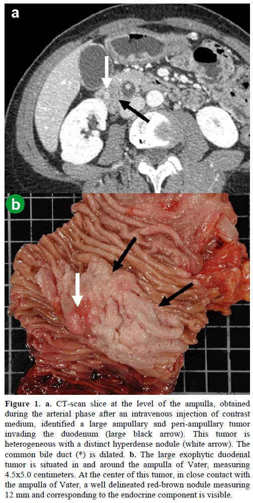 pancreas-ct-scan-slice-level-ampulla