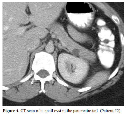 pancreas-ct-scan-small-cyst