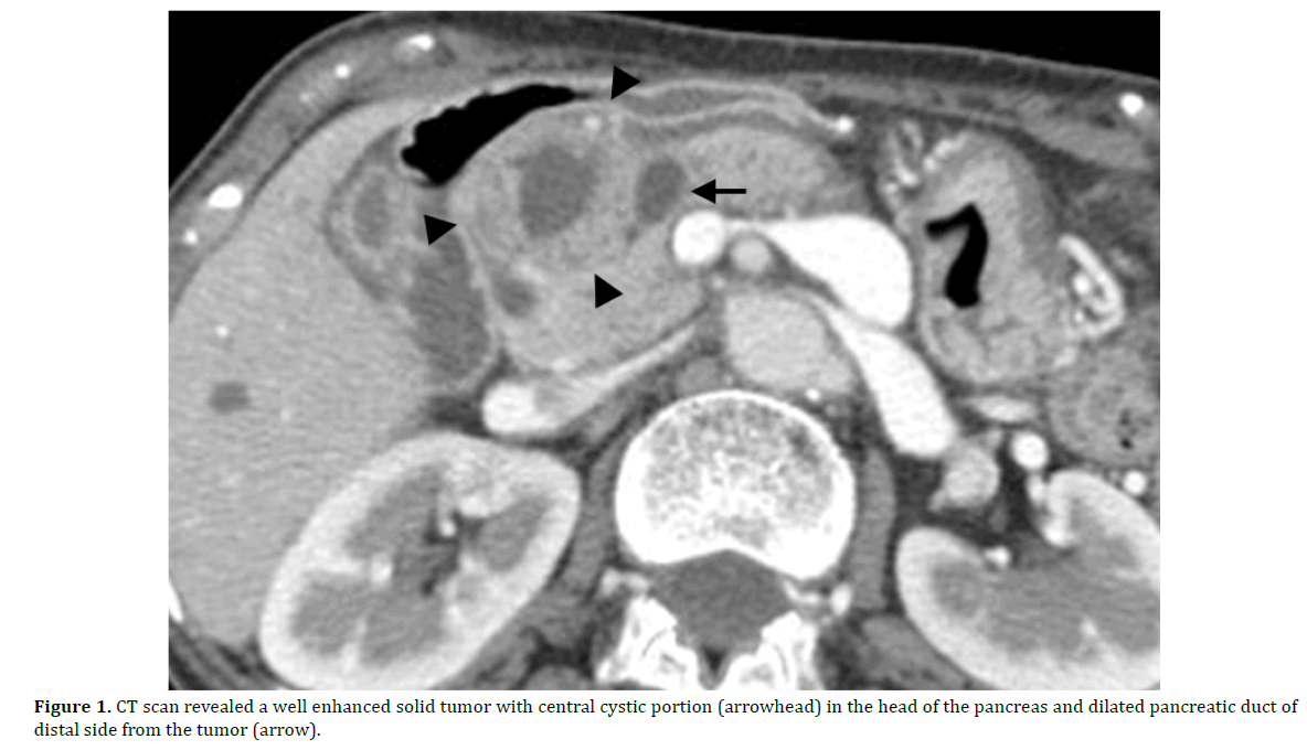 pancreas-ct-scan-solid-tumor-cystic
