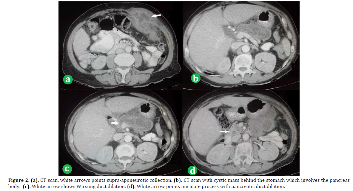 pancreas-ct-scan-supra-aponeurotic