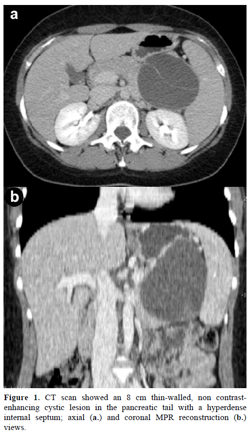 pancreas-ct-scan-thin-walled-cystic-lesion