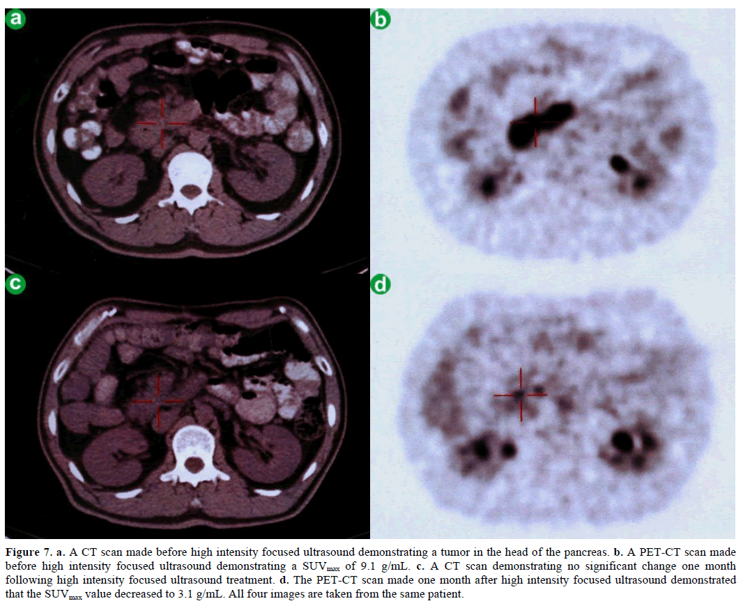 pancreas-ct-scan-ultrasound-demonstrating