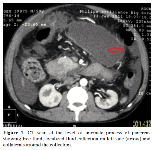 pancreas-ct-scan-uncinate-process