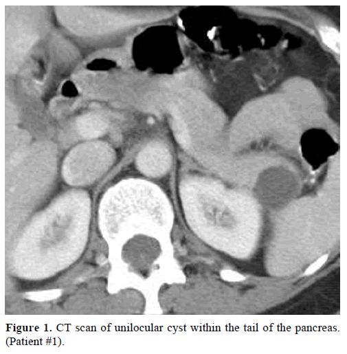 pancreas-ct-scan-unilocular-cyst