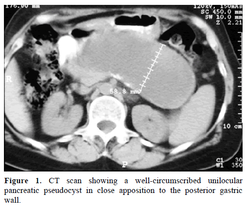 pancreas-ct-scan-well-circumscribed