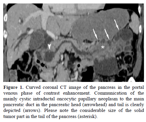 pancreas-curved-coronal-ct-image-pancreas