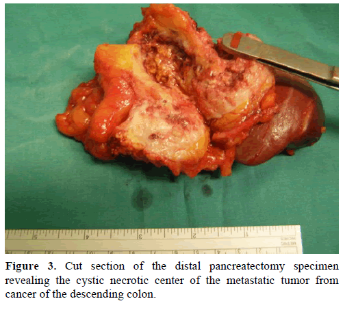 pancreas-cut-section-pancreatectomy