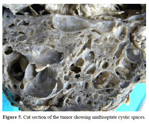 pancreas-cut-section-tumor-multiseptate