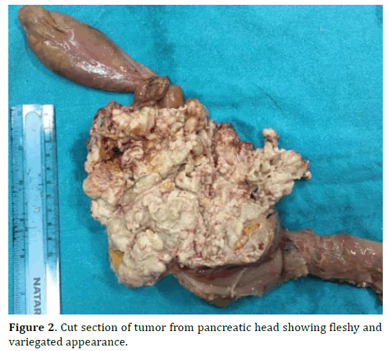 pancreas-cut-section-tumor-variegated