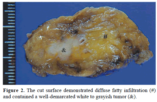 pancreas-cut-surface-diffuse-infiltration