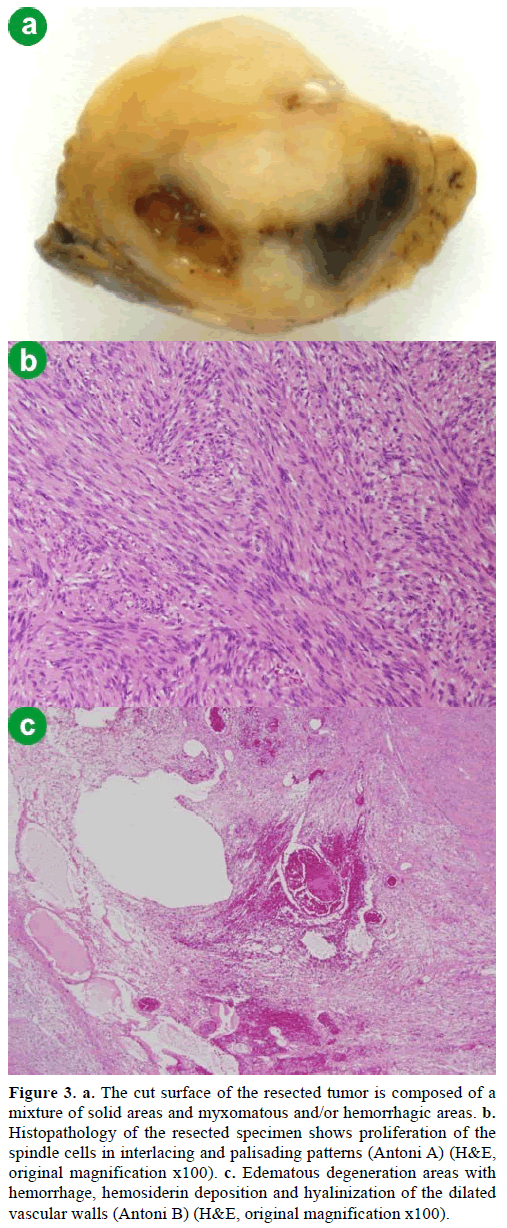 pancreas-cut-surface-tumor-mixture