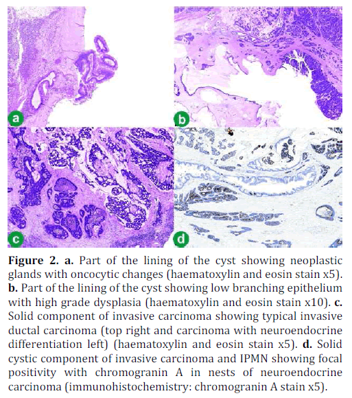 pancreas-cyst-neoplastic-glands