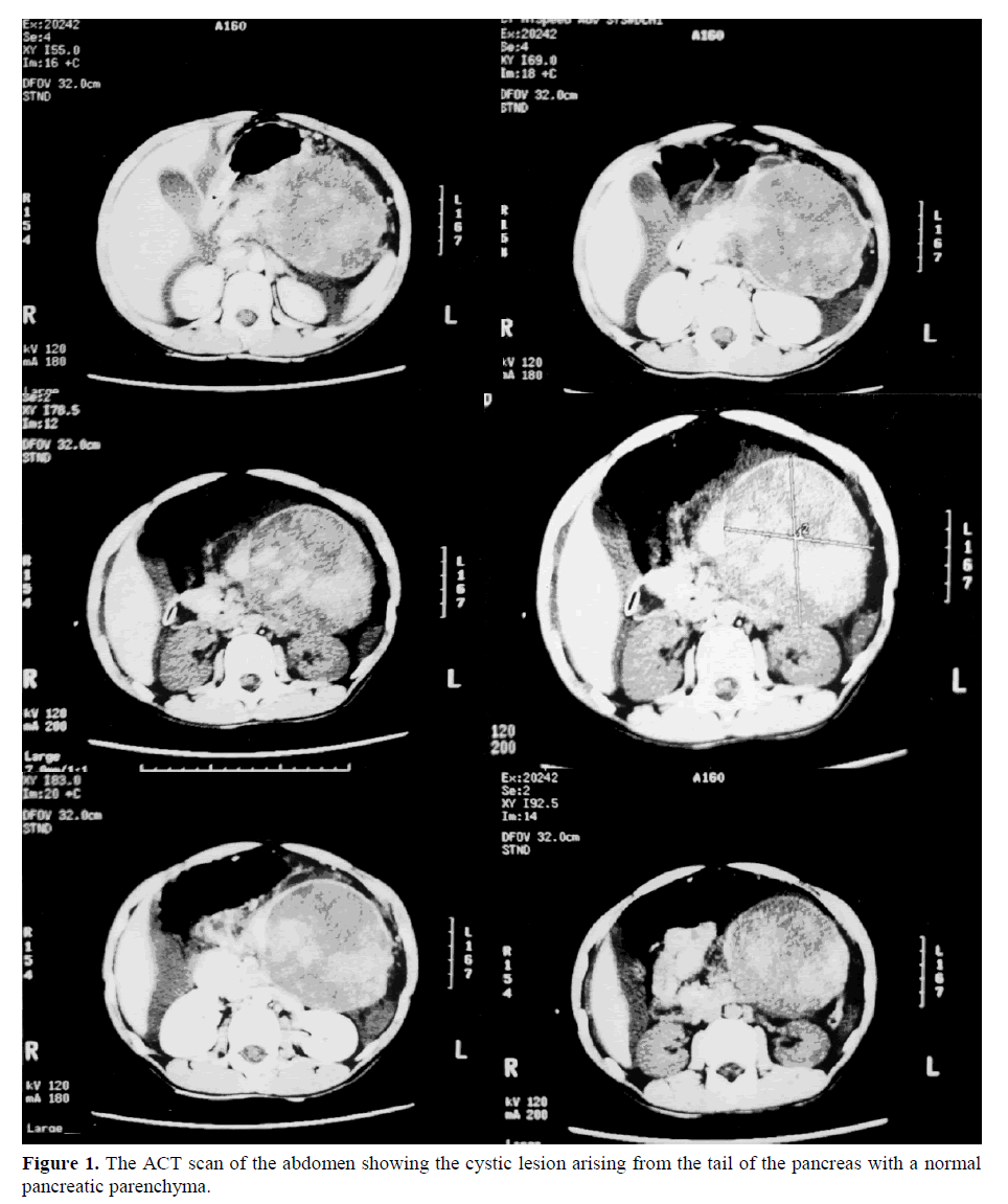 pancreas-cystic-lesion-arising