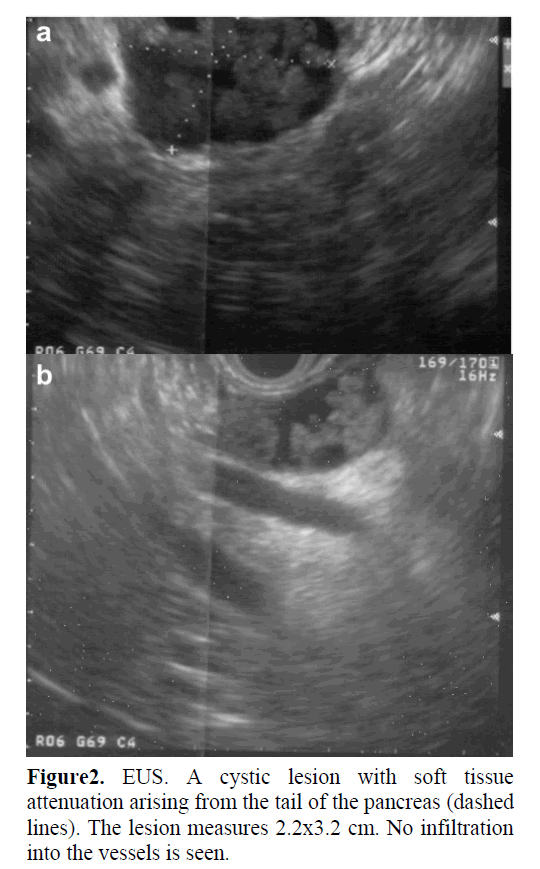 pancreas-cystic-lesion-soft-tissue