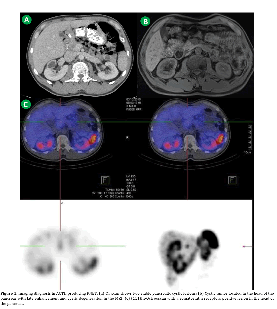 pancreas-cystic-lesions