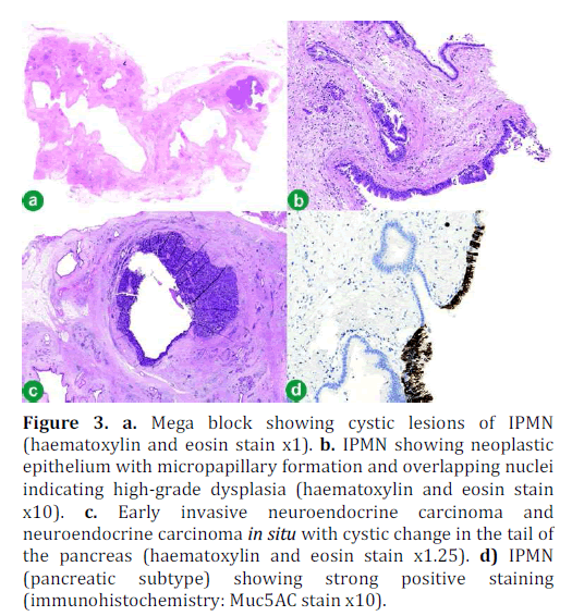 pancreas-cystic-lesions-haematoxylin