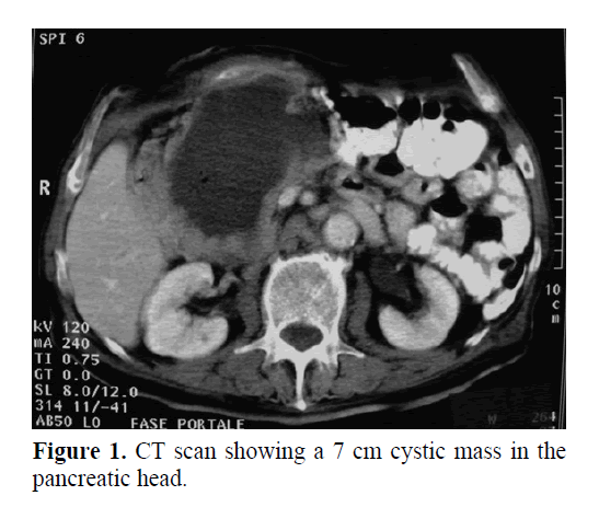pancreas-cystic-mass-pancreatic-head