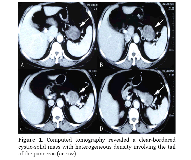 pancreas-cystic-solid-mass