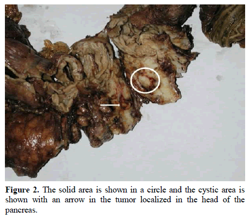 pancreas-cystic-tumor-pancreas