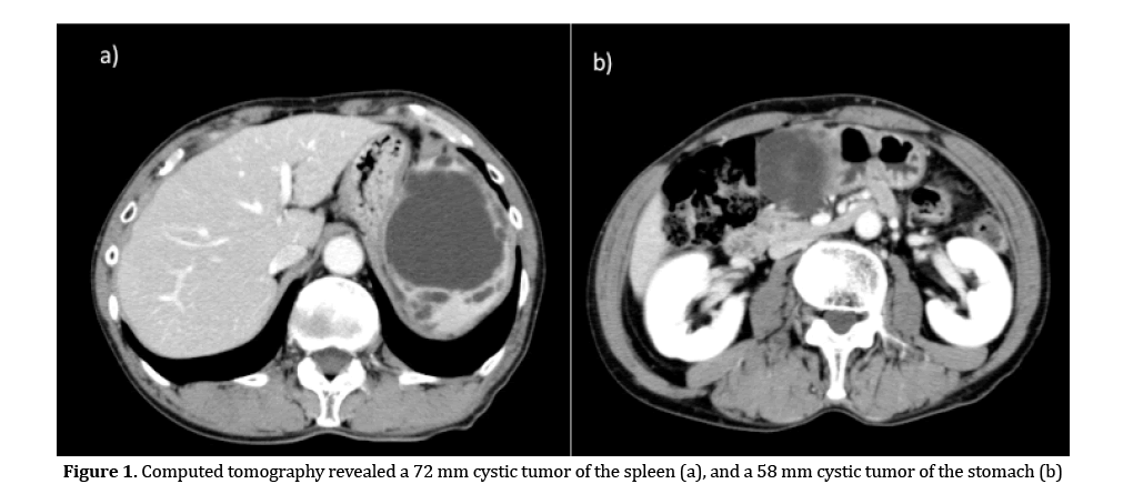 pancreas-cystic-tumor-stomach