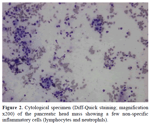 pancreas-cytological-specimen-mass