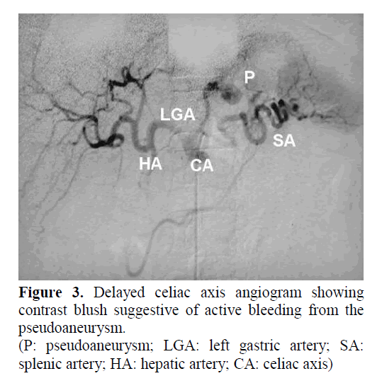 pancreas-delayed-celiac-axis-angiogram