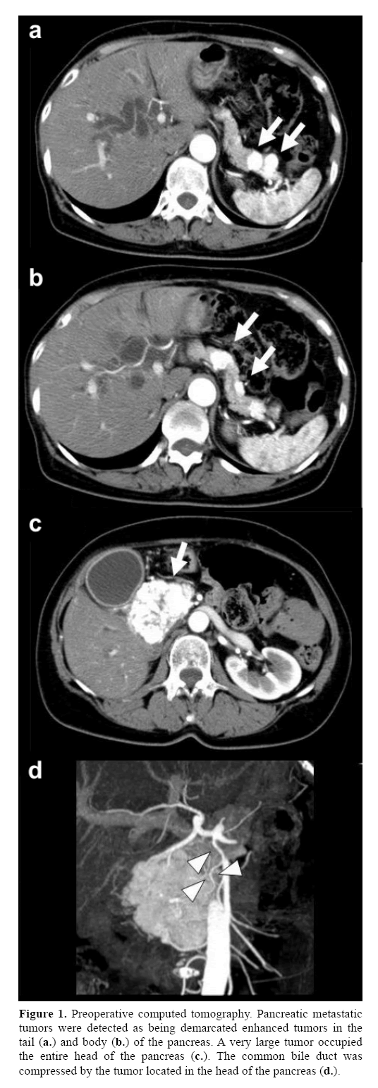 pancreas-demarcated-enhanced-tumors