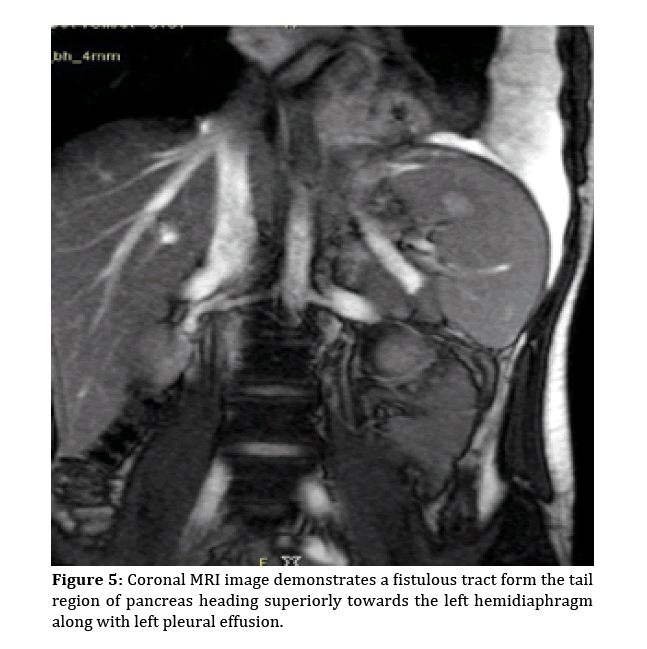 pancreas-demonstrates-fistulous-tract