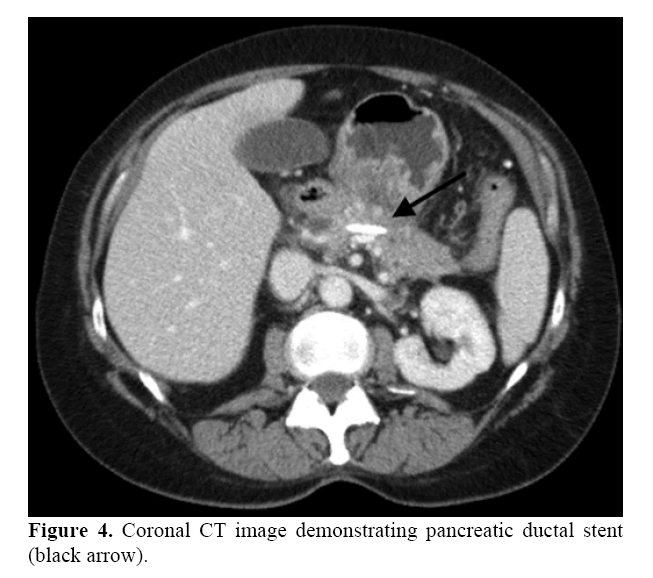 pancreas-demonstrating-pancreatic