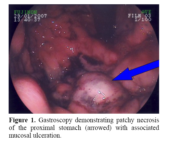 pancreas-demonstrating-patchy-necrosis