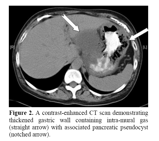 pancreas-demonstrating-patchy-necrosis