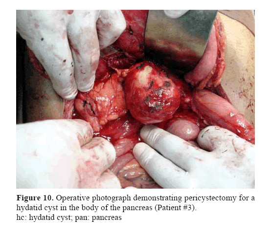 pancreas-demonstrating-pericystectomy
