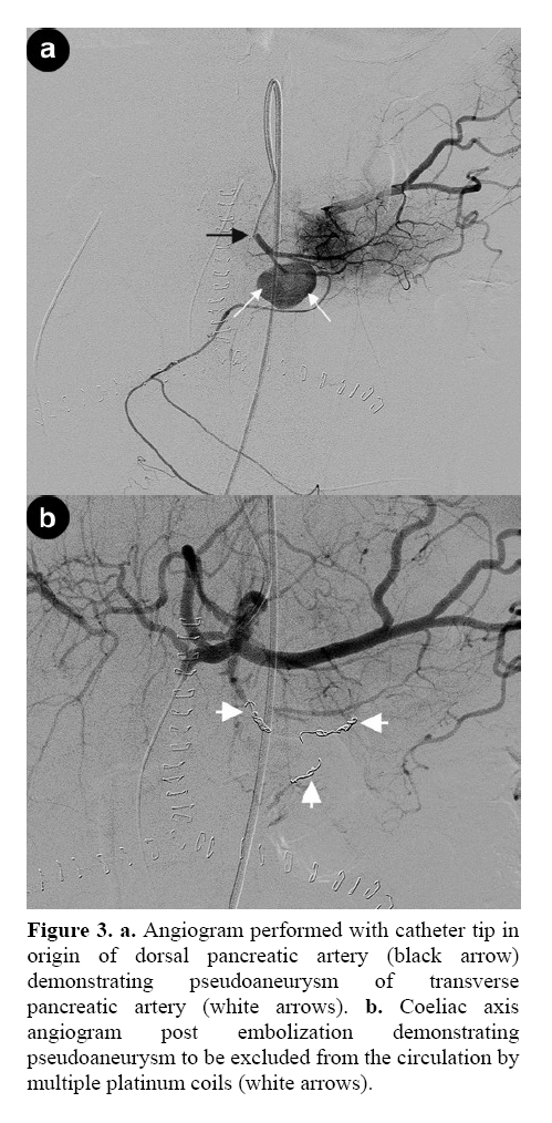 pancreas-demonstrating-pseudoaneurysm