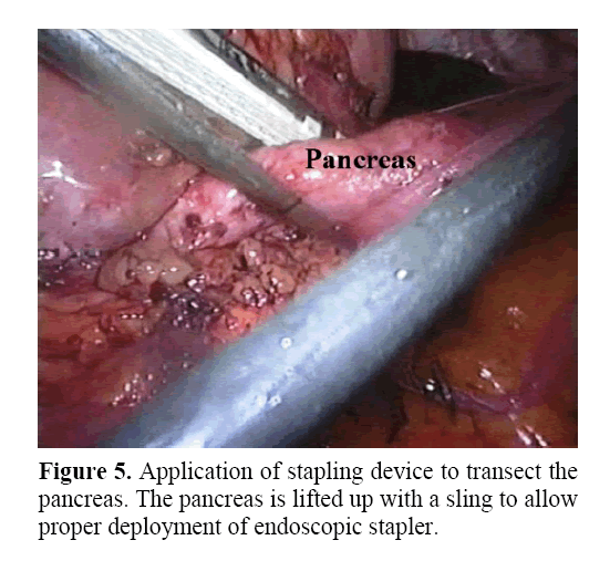 pancreas-deployment-endoscopic-stapler