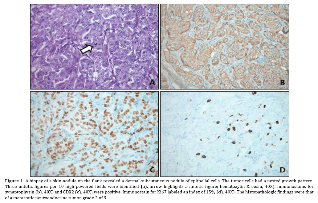 pancreas-dermal-subcutaneous