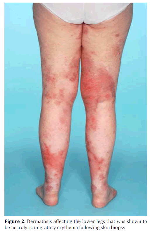 pancreas-dermatosis-affecting-lower-legs