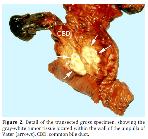 pancreas-detail-transected-gross