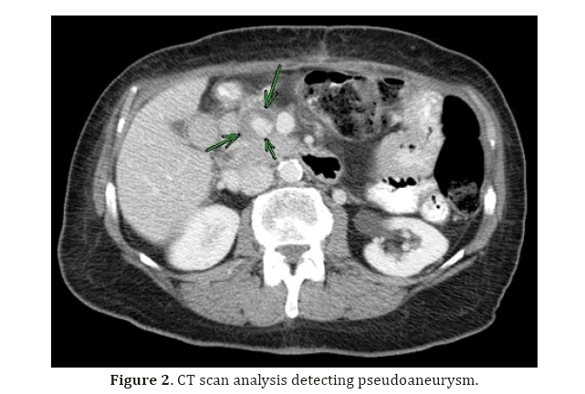 pancreas-detecting-pseudoaneurysm