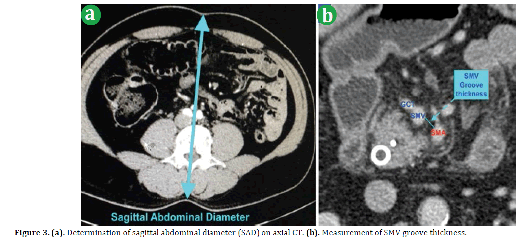 pancreas-determination-sagittal