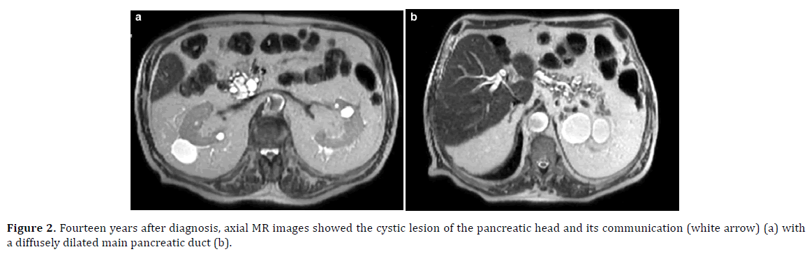 pancreas-diagnosis-cystic-lesion