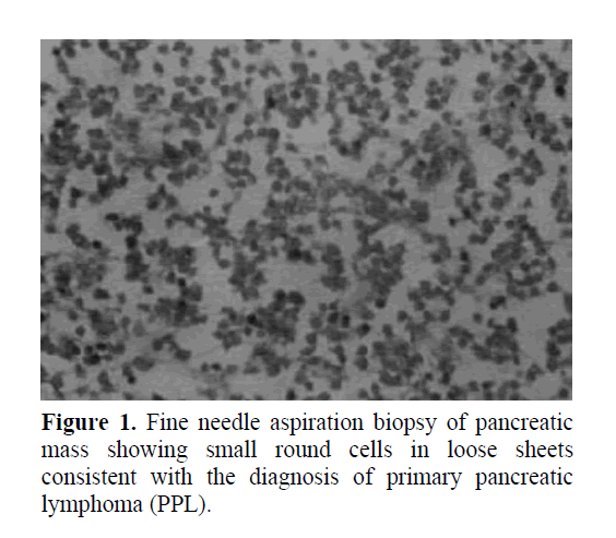 pancreas-diagnosis-primary-pancreatic