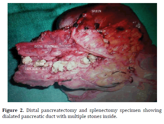 pancreas-dialated-pancreatic