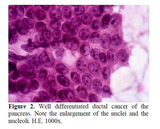 pancreas-differentiated-ductal-cancer
