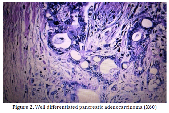 pancreas-differentiated-pancreatic-adenocarcinoma