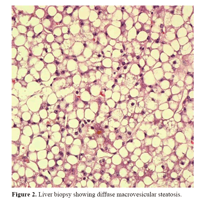 pancreas-diffuse-macrovesicular-steatosis