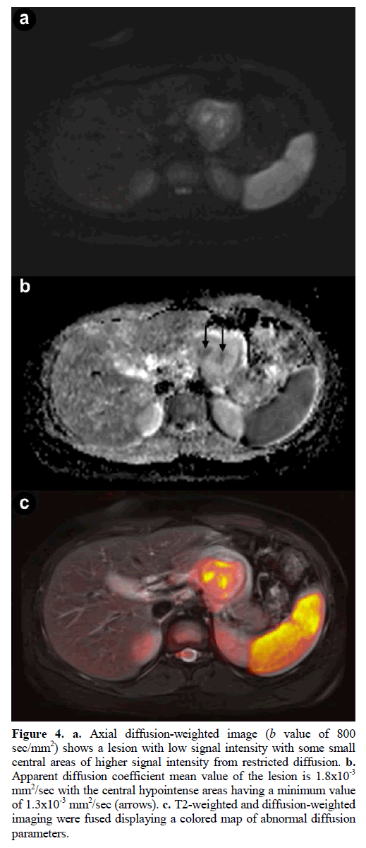 pancreas-diffusion-weighted-signal