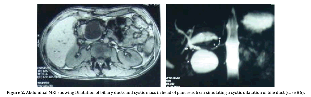 pancreas-dilatation-biliary-ducts
