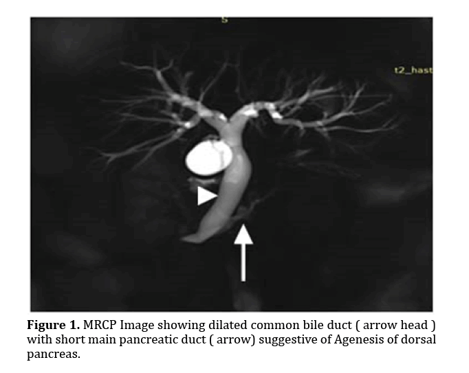 pancreas-dilated-common-bile-duct