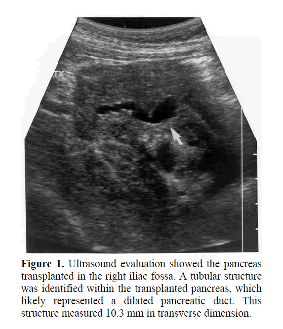 pancreas-dilated-pancreatic-duct