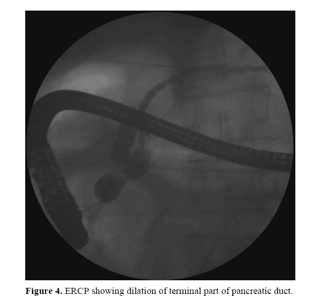 pancreas-dilation-terminal-part